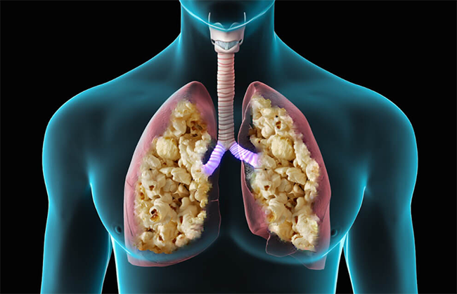 Болезнь "Попкорн лёгких" и связь с использованием электронных сигарет